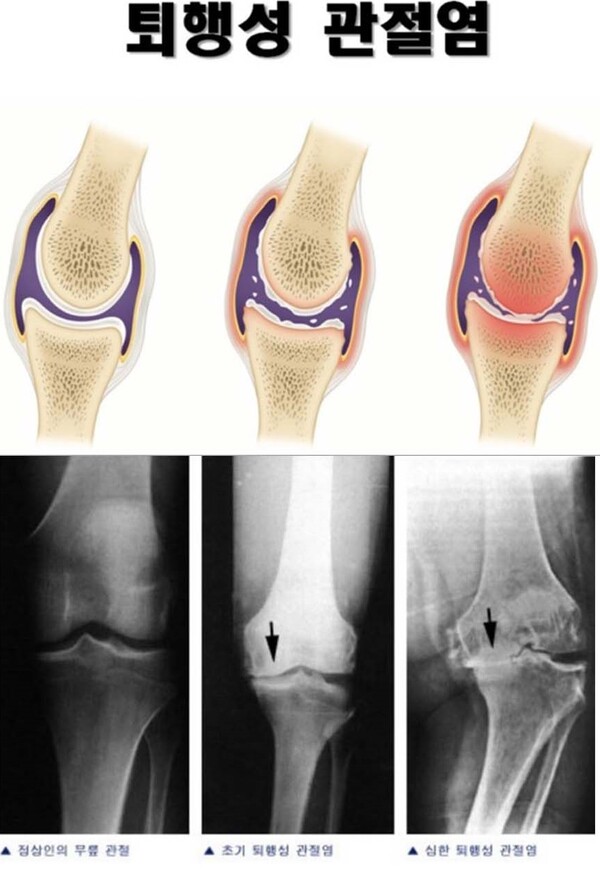 무릎 관절 등이 좋지 않은 노인에게 쭈그려 앉아 변을 보는 행위는 퇴행성 관절염으로 이어질 수 있어 치명적이다. /사진=독자 제공
