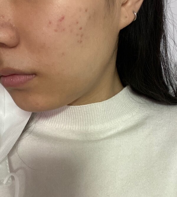 마스크로 인한 피부 트러블을 겪고 있는 20대 여성의 피부 상태. 마스크 안쪽 피부의 상태가 유난히 좋지 않음을 알 수 있다. /이서빈