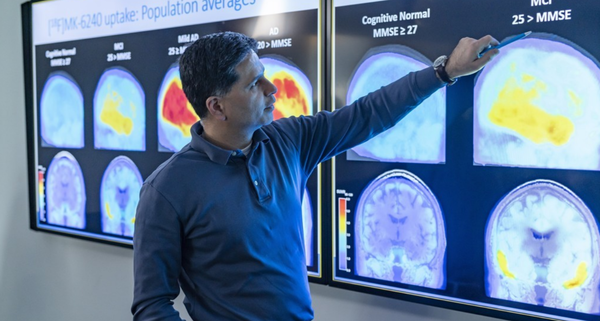 알츠하이머 환자와 일반인의 뇌 스캔 사진. / EPA=연합뉴스