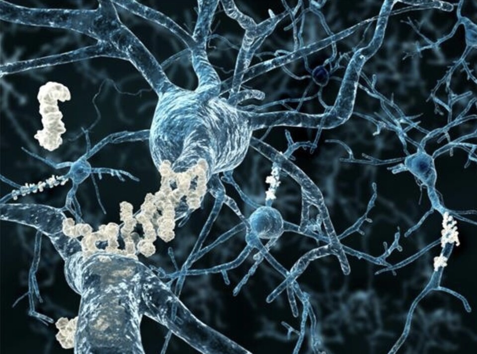 뇌신경에 형성된 베타 아밀로이드 플라그 /게티이미지뱅크