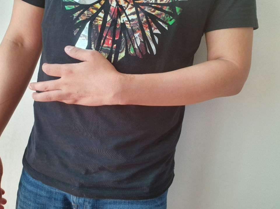 복합부위통증증후군(CRPS) 환자가 질환을 앓는 왼손 붕대를 풀었을 때의 모습. /연합뉴스