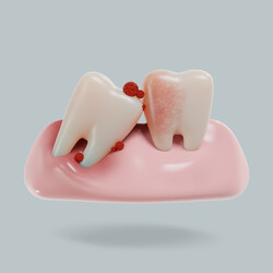 오염된 날카로운 것에 피부가 찢기면 피가 나고 곪게 되는데 치아에서도 똑같은 현상이 생깁니다. 다만 치아의 표면은 피부와는 달리, 날카로운 것에는 영향을 받지 않고 충치균에 의해서 찢긴다고 생각하면 이해하기가 쉽습니다. /게티이미지뱅크