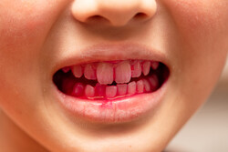 입안 출혈 시 피가 많이 보여 매우 놀라게 되지만 입안 출혈은 생각보다 실제로 흘리는 피의 양이 많지 않다. /게티이미지뱅크