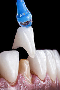 회복이 힘들 정도의 넓은 손상에는 크라운 치료를 하게 된다. /게티이미지뱅크