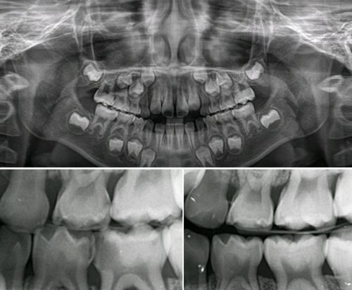 파노라마 방사선 사짐 및 치아사이의 충치를 검사하는 교익사진