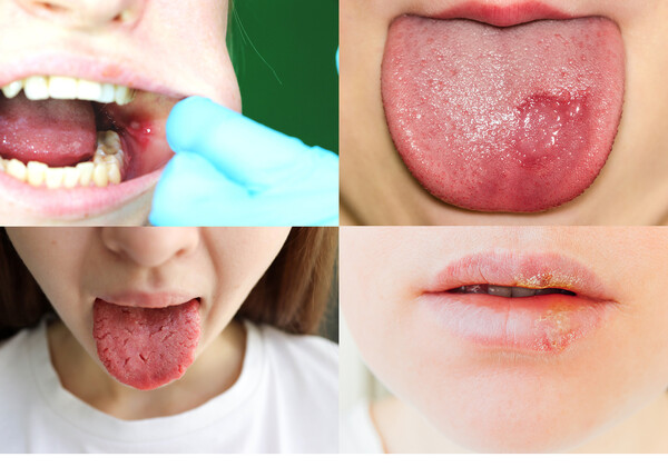 다양한 구강 연조직 질환 사진. (왼쪽 위부터 시계 방향으로) 구내염, 혀 염증, 헤르페스성 감염, 구강 건조증 /게티이미지뱅크