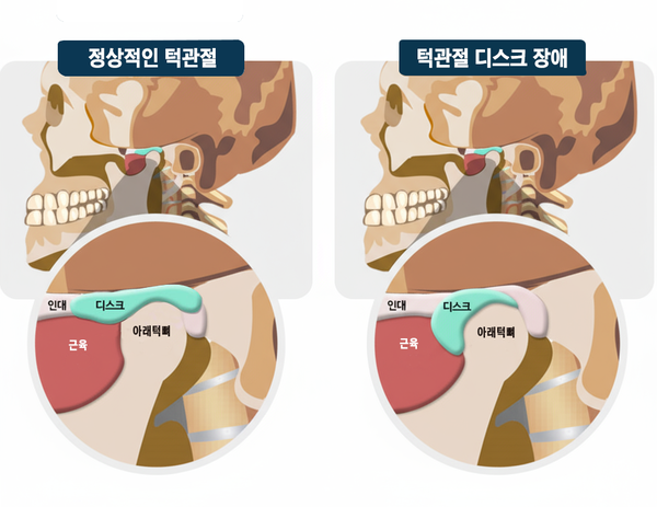 정상적인 턱관절과 턱관절 디스크 장애 /나노바나나
