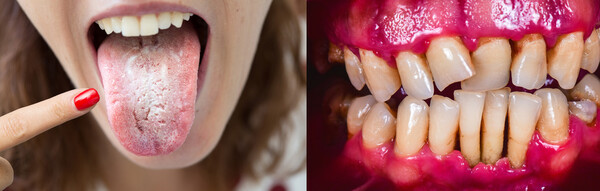 구취의 원인이 되는 설태(왼쪽)와 잇몸 염증 /게티이미지뱅크